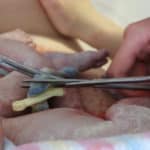 cutting umbliical cord at time of birth