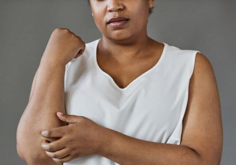 woman itching arm due to cholestasis in pregnancy