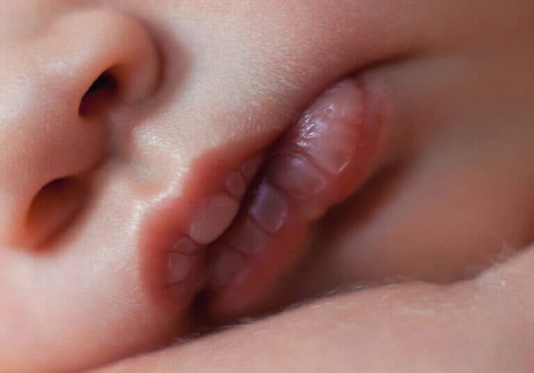 Newborn Lip Blister