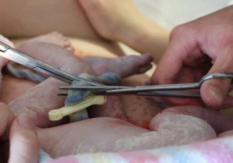 cutting umbliical cord at time of birth